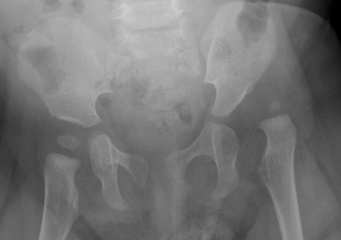 xray ddh
