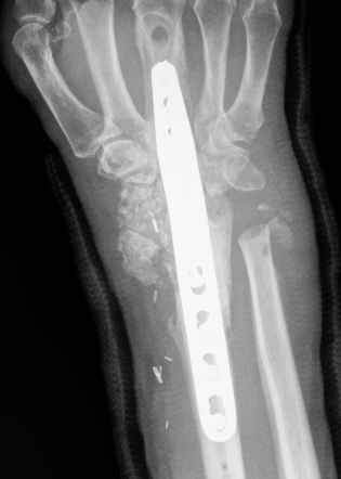 infection