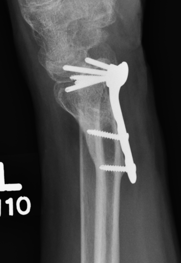 malunion