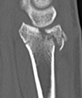 Dorsal fragments