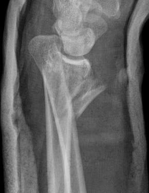ulna styloid