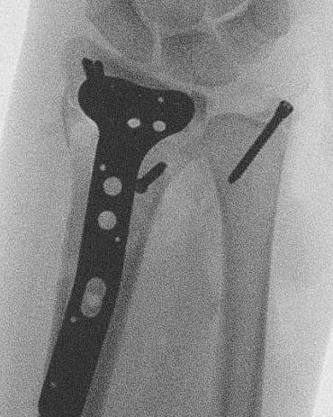 ulna styloid