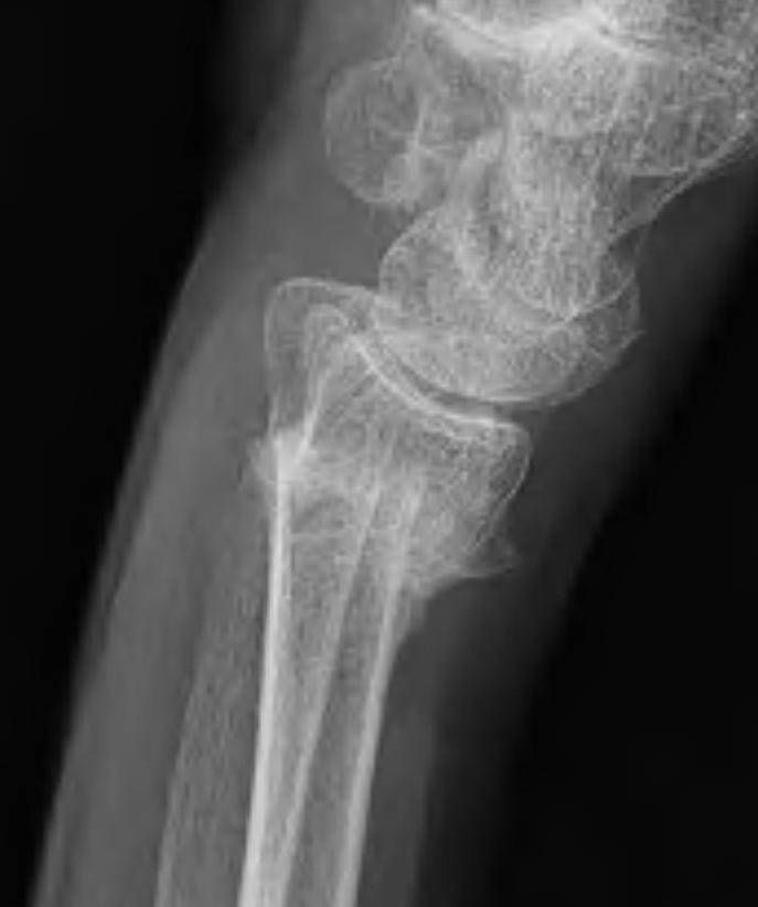 malunion