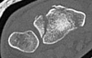 Simoid notch