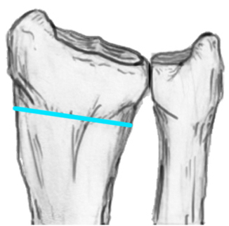 Type I