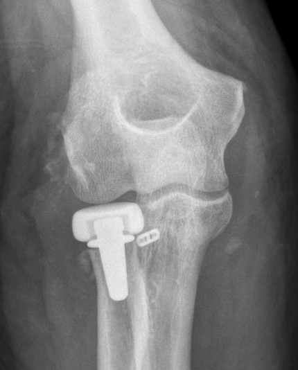 coronoid
