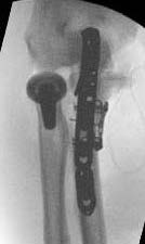 coronoid