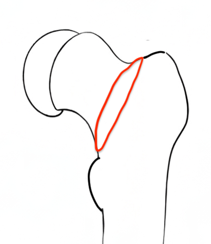 osteotomy