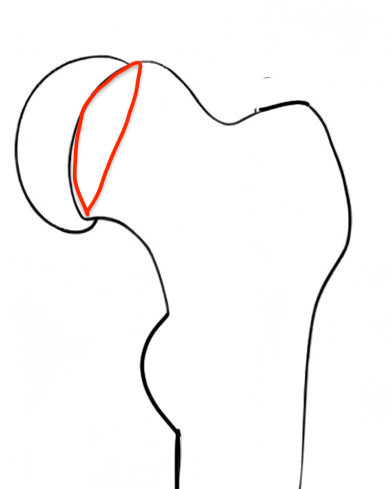 Osteotomy