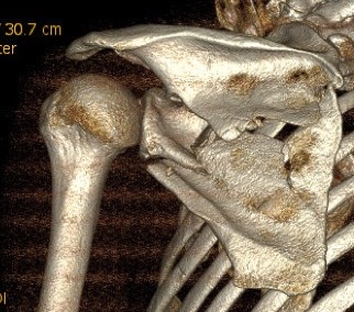 scapula