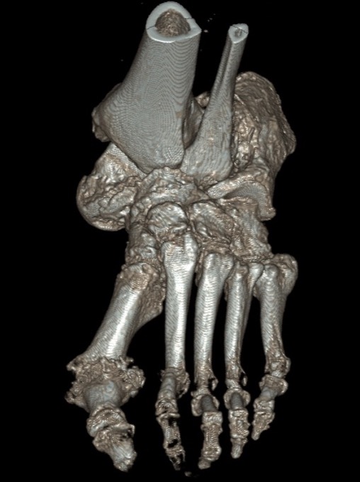 charcot