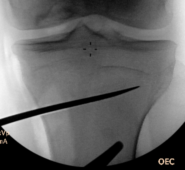 HTO Osteotomy