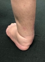 charcot