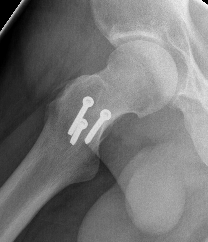 Hip PVNS dislocation