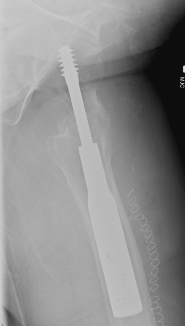 Pin and plate lateral
