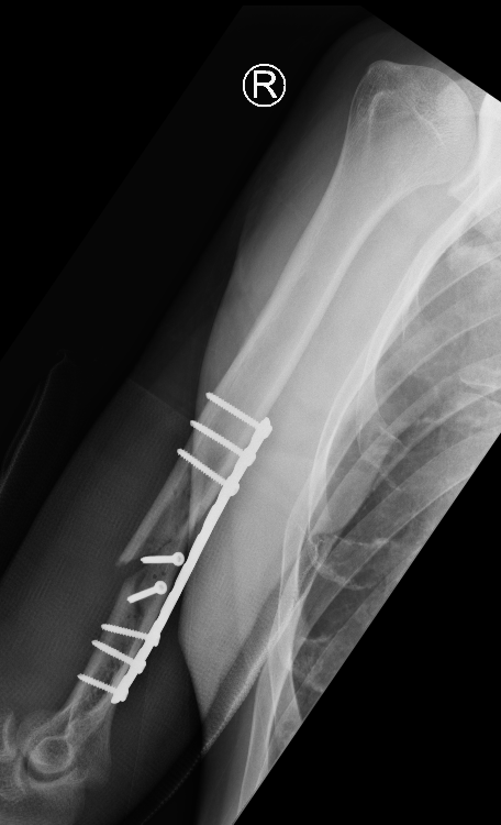 Nonunion