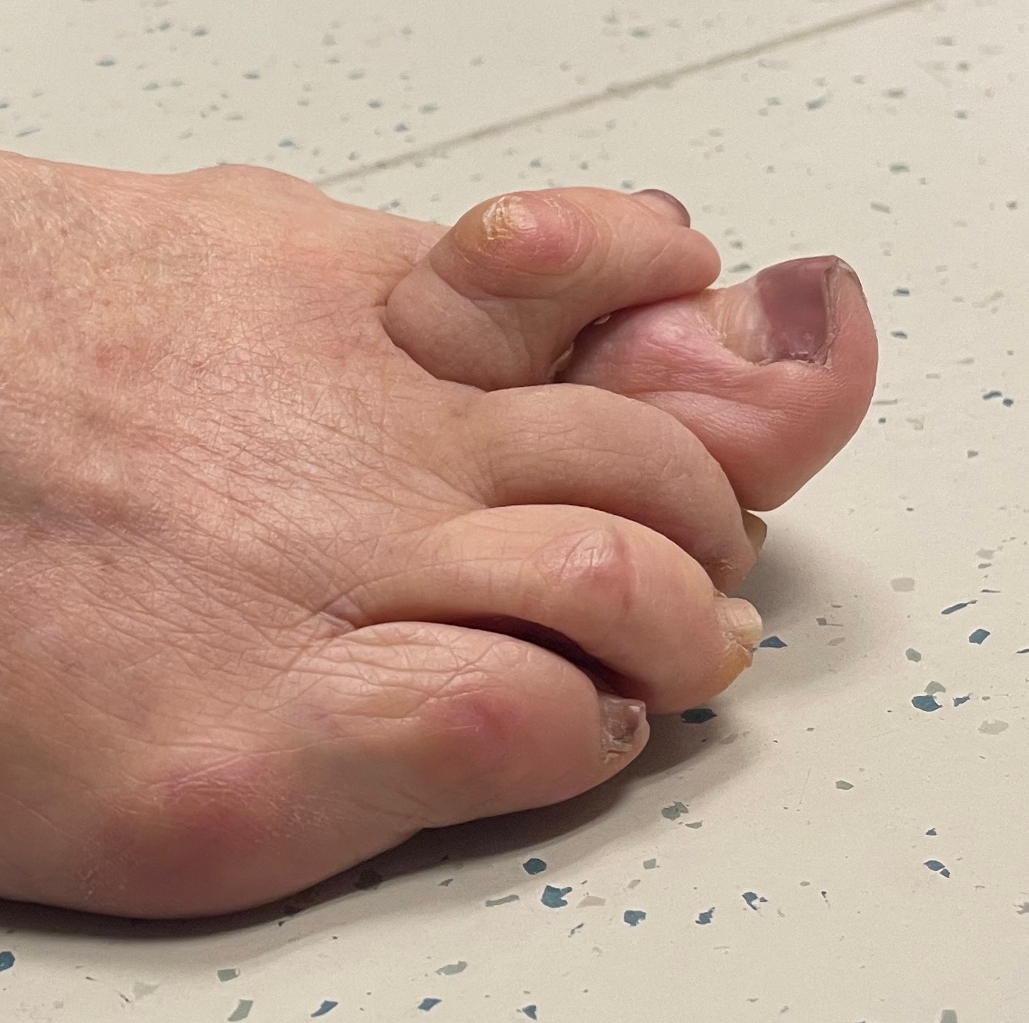 Hammer toe