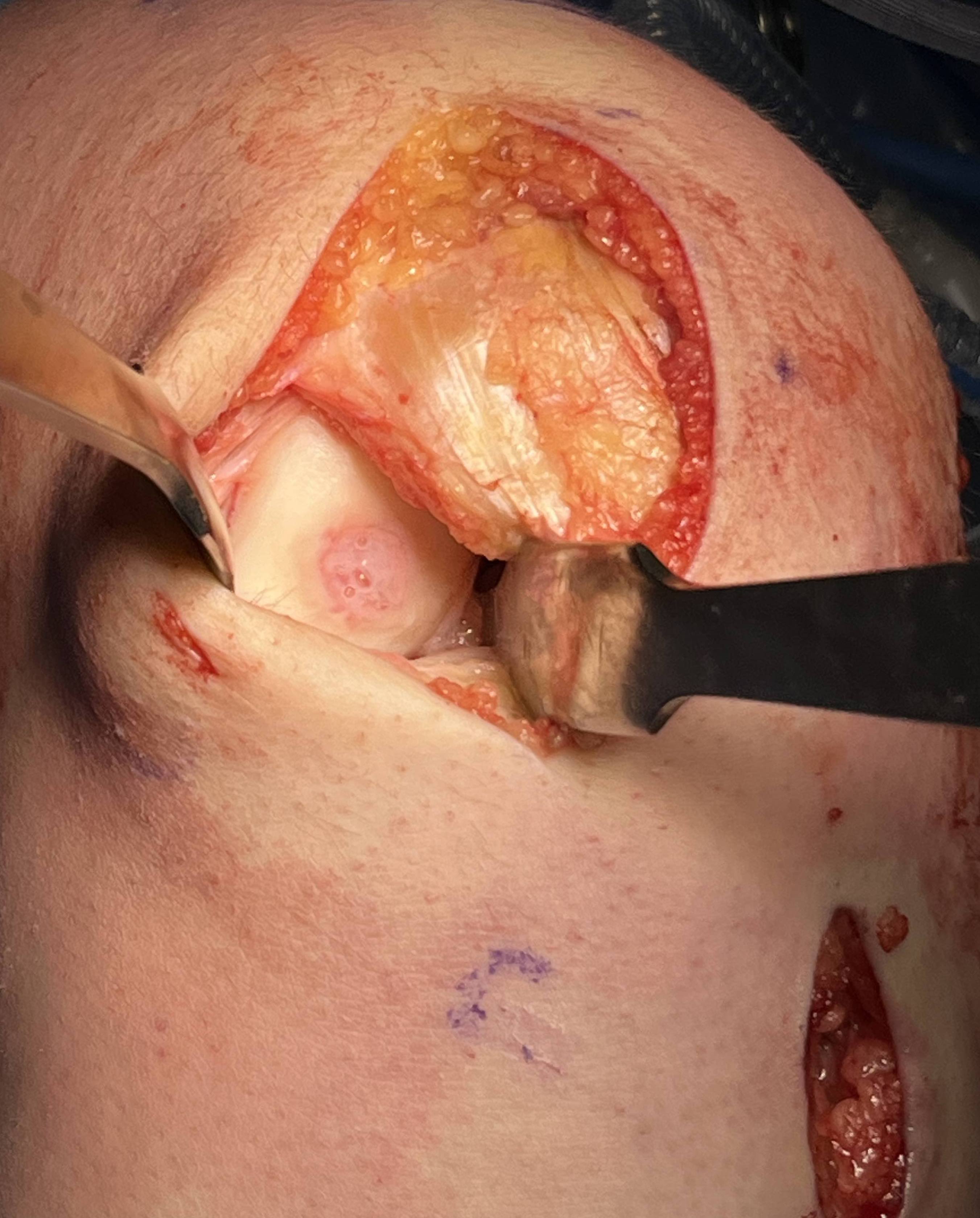 Patella AMIC