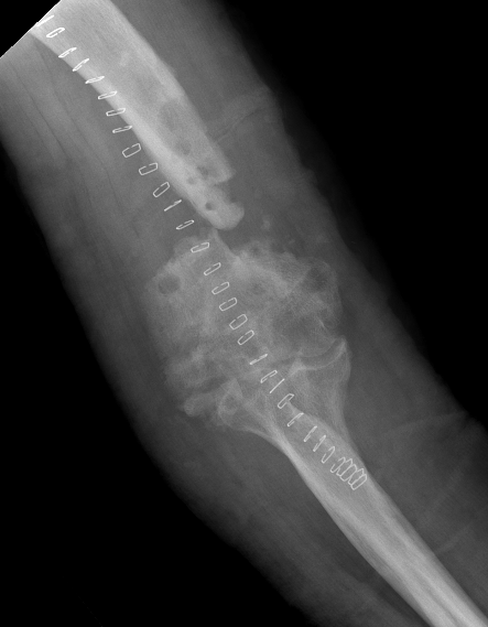 infection