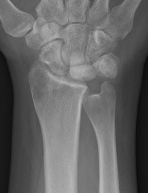 radial short