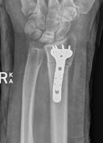 radial short
