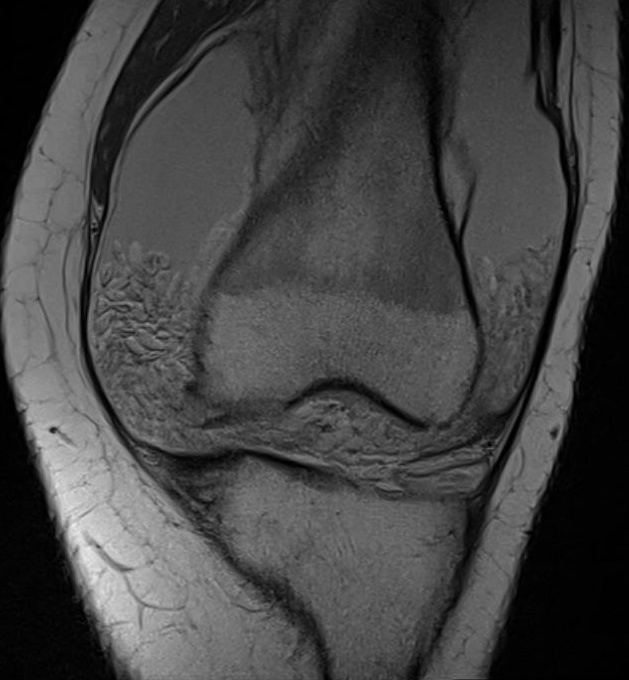 Arborsescens MRI