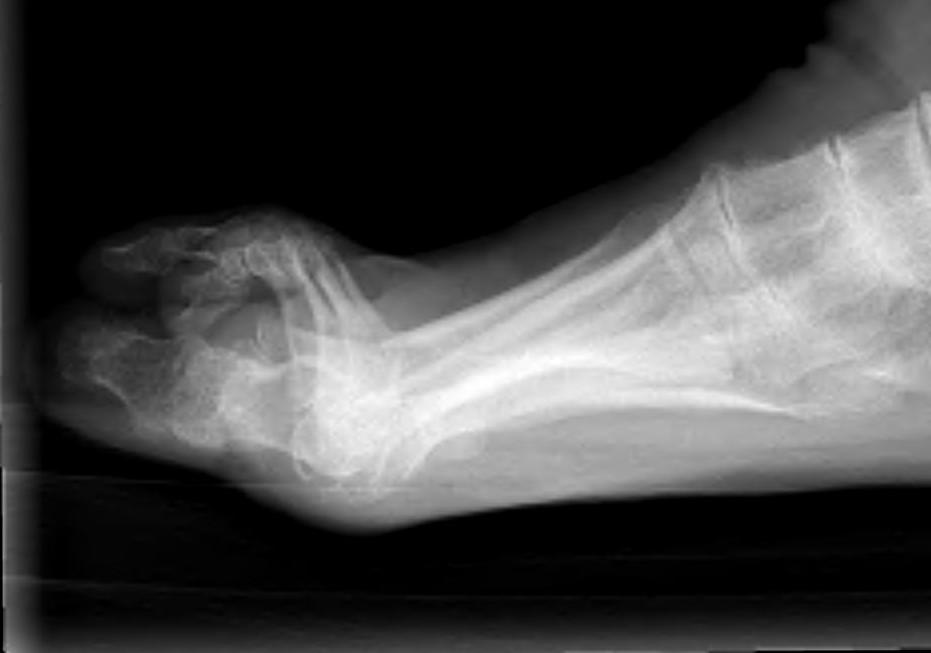RA foot