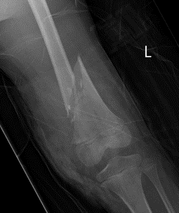 Dis femur
