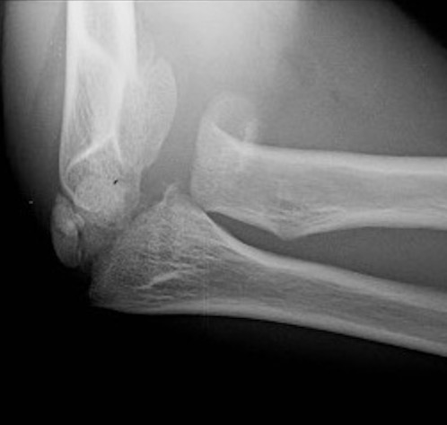 radial neck