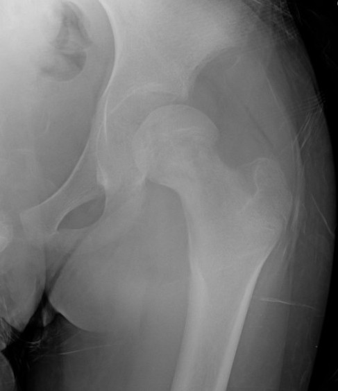 Septic arthritis