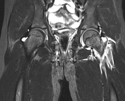 Septic arthritis