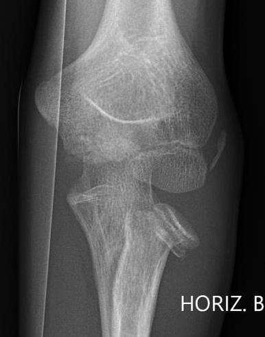 Radial neck