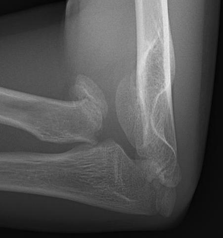 Radial neck 