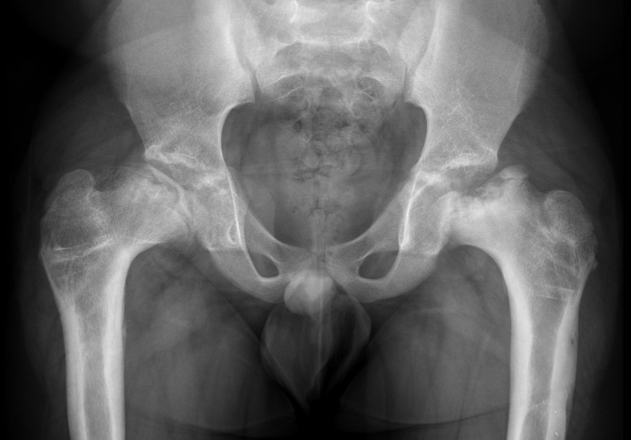 perthes
