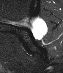 Spinoglenoid