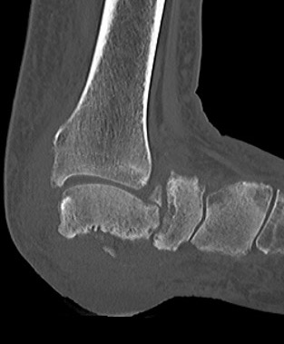charcot