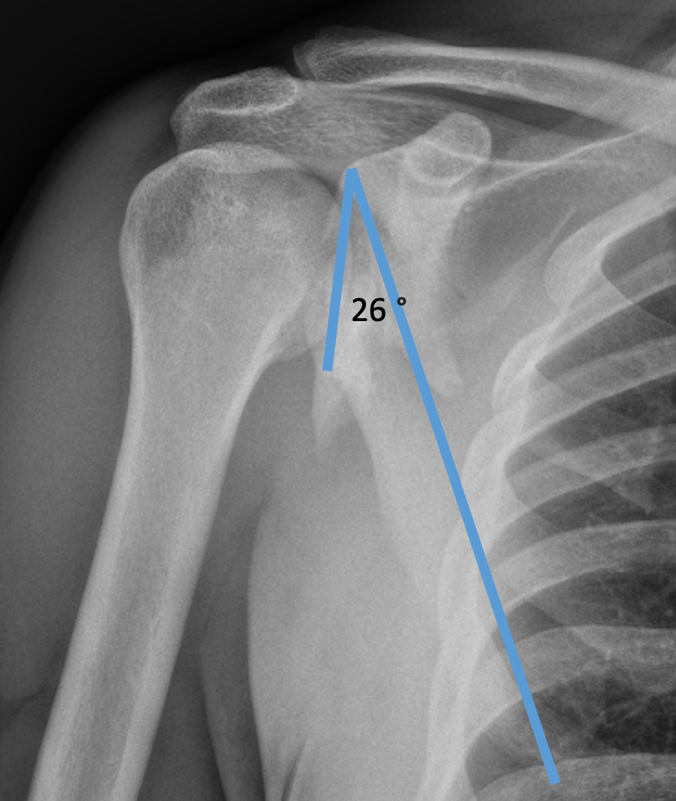 scapula