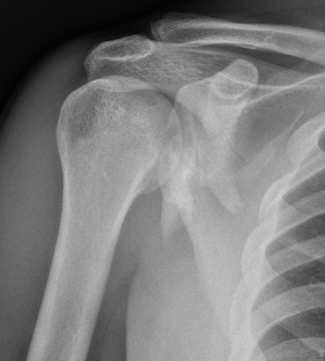 scapula