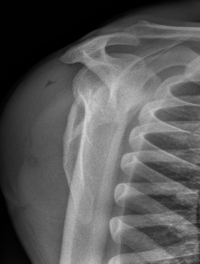 scapula