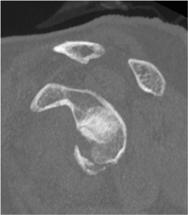acute bony bankart