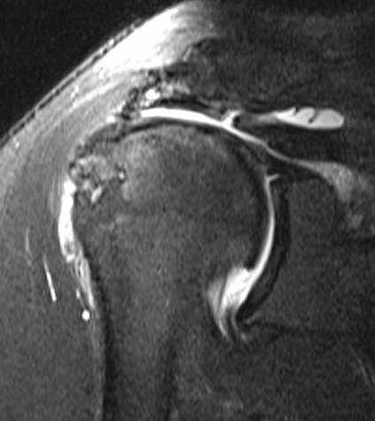 Massive cuff tear