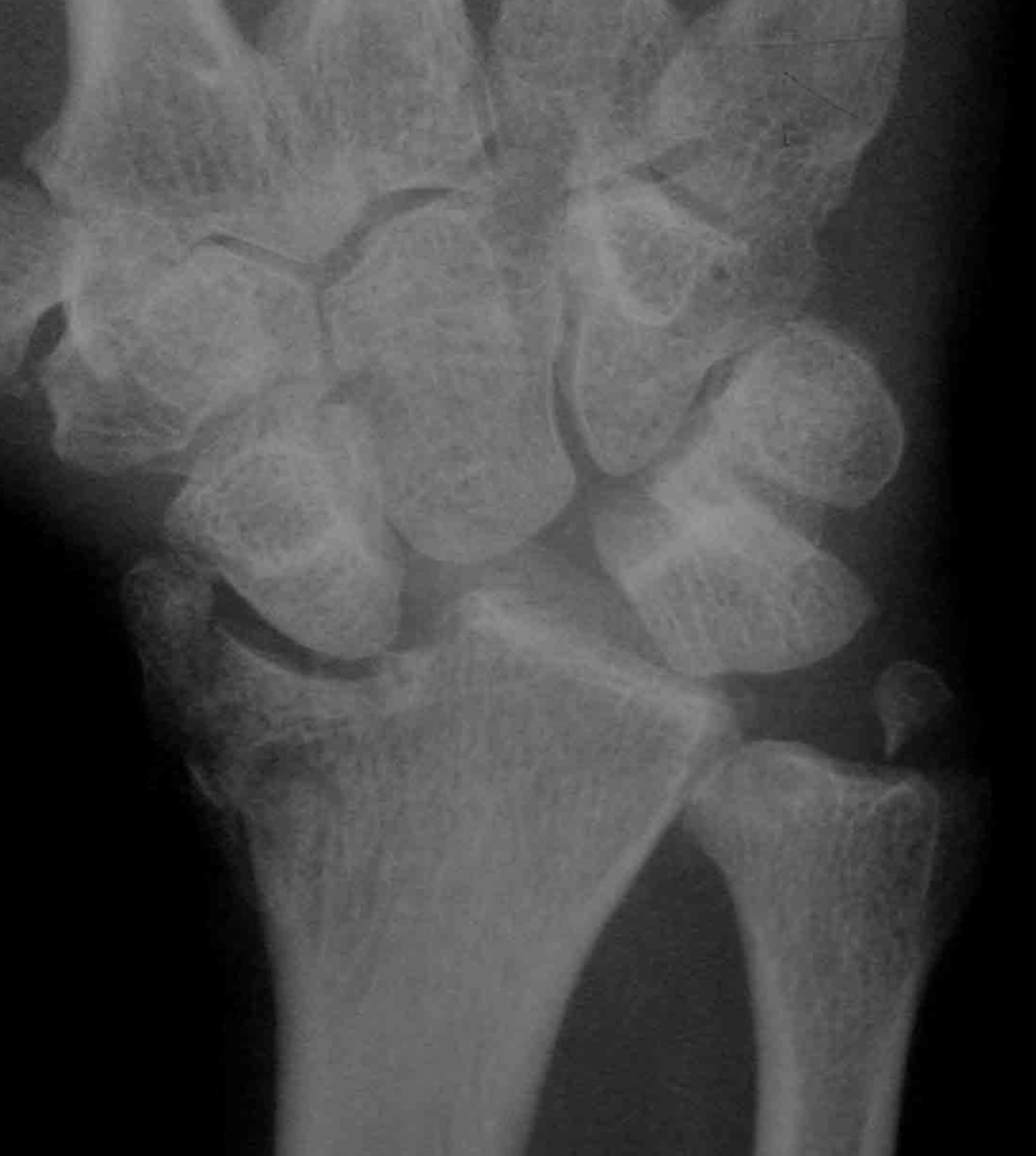 Radial styloid