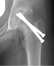 Chondrolysis