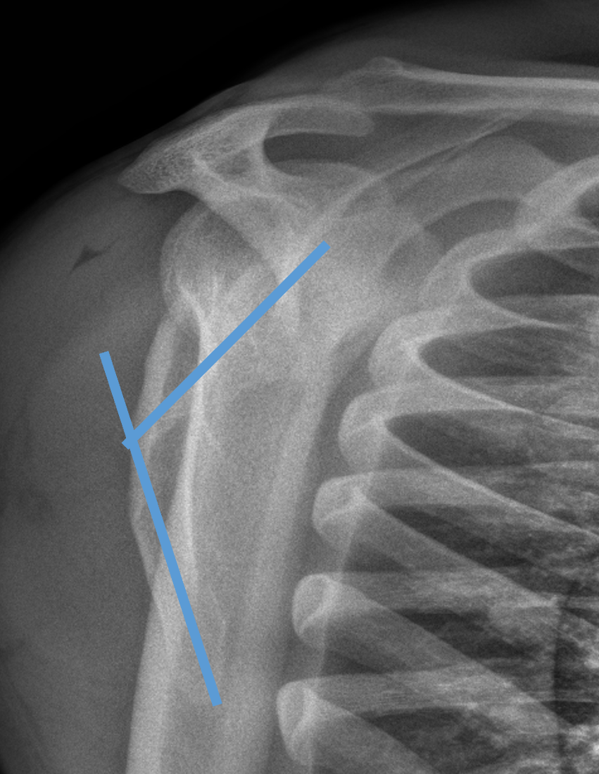 scapula