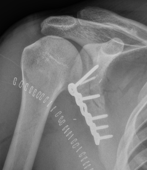 scapula