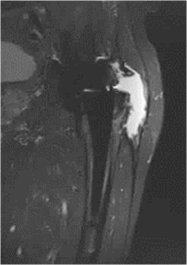 Metallosis MRI