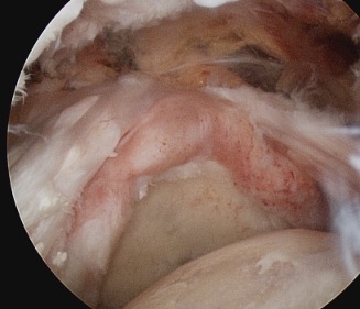 Massive cuff tear