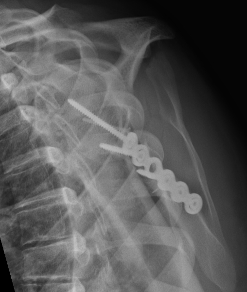 scapula