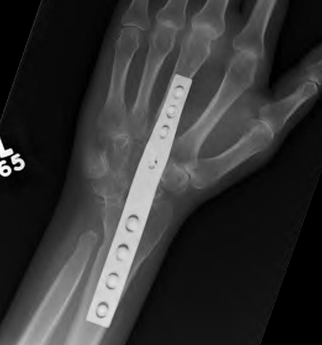 wrist fusion