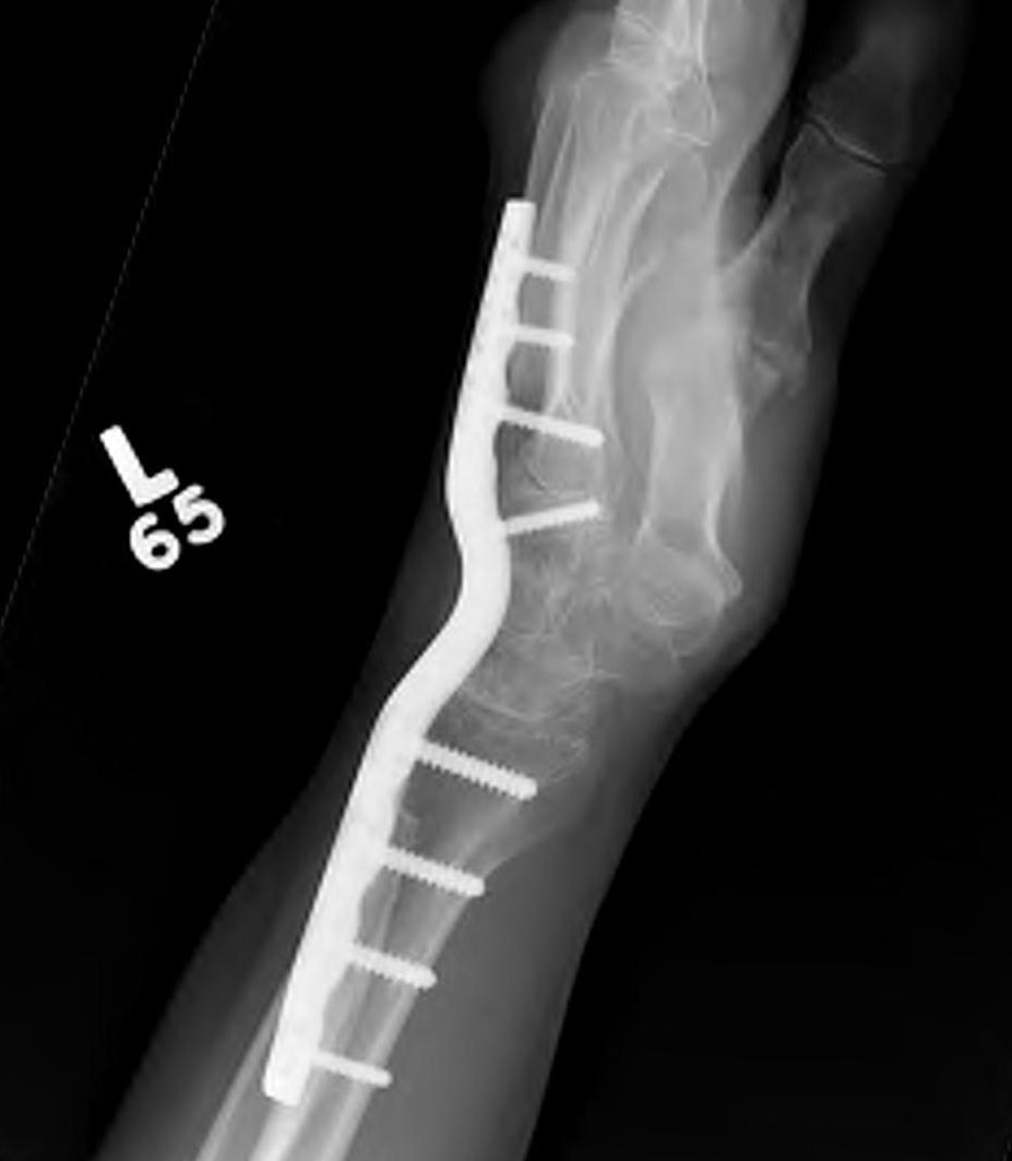 wrist fusion
